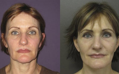 How Much Does a Facelift Cost?