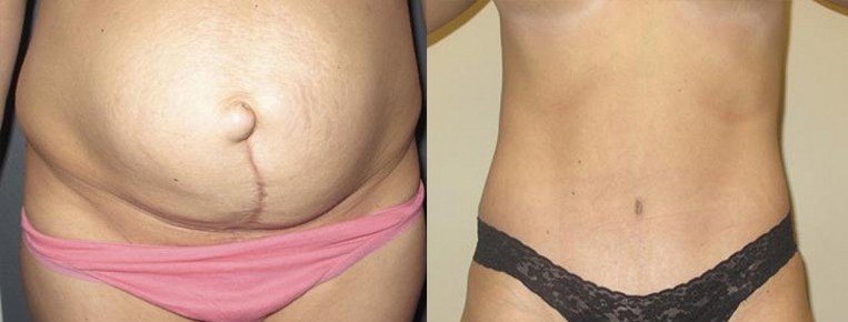What's the Recovery Time for a Tummy Tuck? - Brown Plastic Surgery