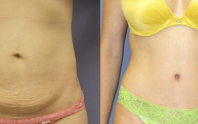 What Happens To My Belly Button During a Tummy Tuck?