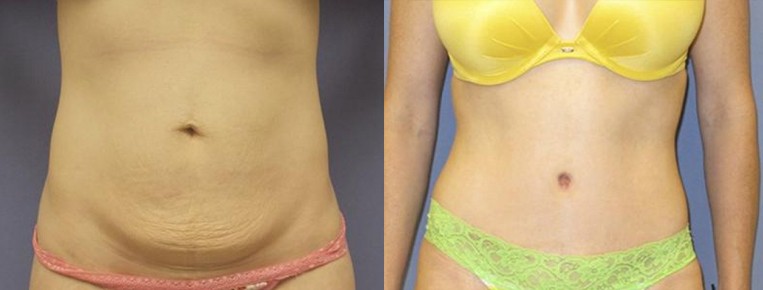 What Happens To My Belly Button During a Tummy Tuck? - Brown Plastic Surgery