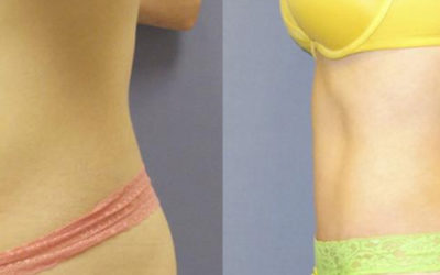 How Much Does a Tummy Tuck Cost?