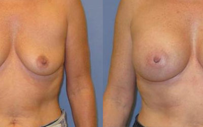 Breast Augmentation and Breast Lift: Can I Combine Them?